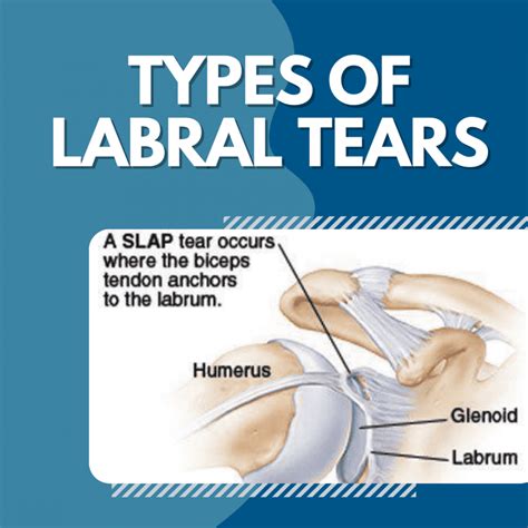 nondisplaced anterosuperior labral tear